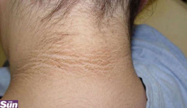 LA 14ENNE NOTA UNA MACCHIA SUL SUO COLLO: "È SPORCO?". MA DAI MEDICI LA BRUTTA NOTIZIA