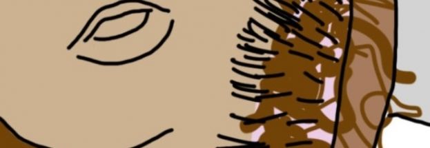 HAI MAI NOTATO QUALCOSA DI SIMILE NEI TUOI CAPELLI?POTREBBE TRATTARSI DI CANCRO OVARICO:I SINTOMI